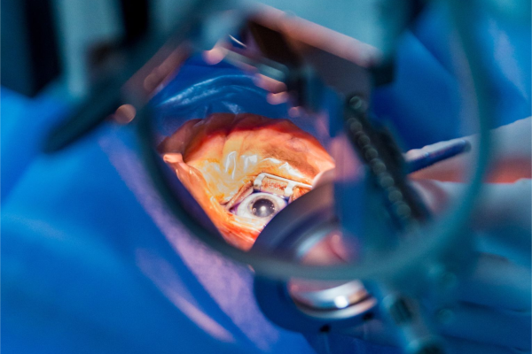 Retinal detachment surgery 1080'750