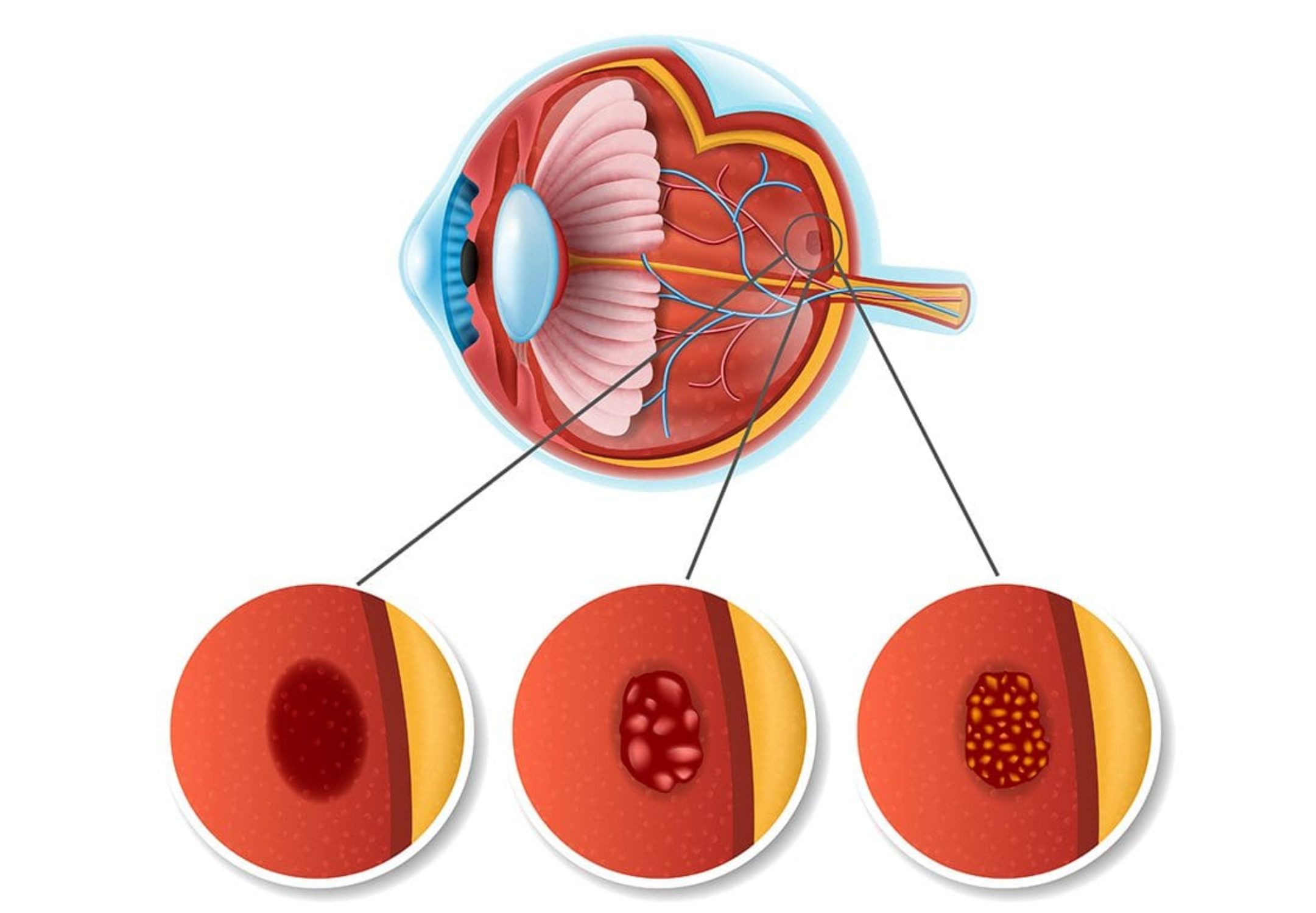 AMD treatment 1080'750