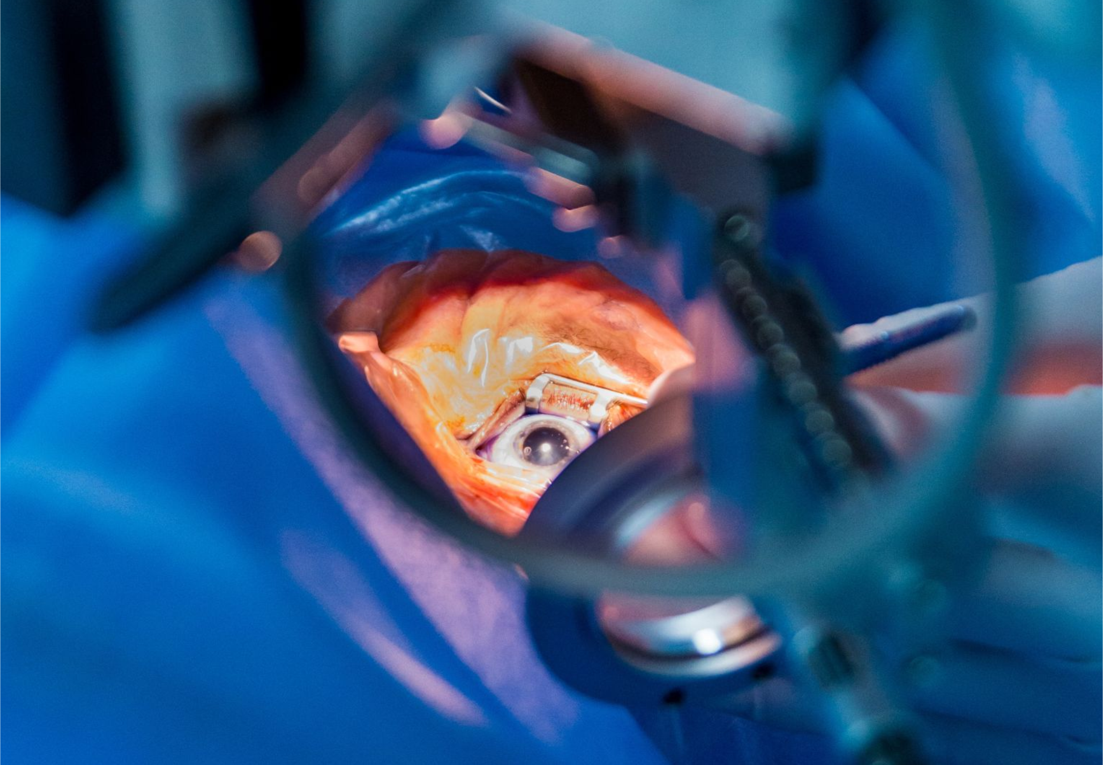 Retinal detachment surgery 1080'750